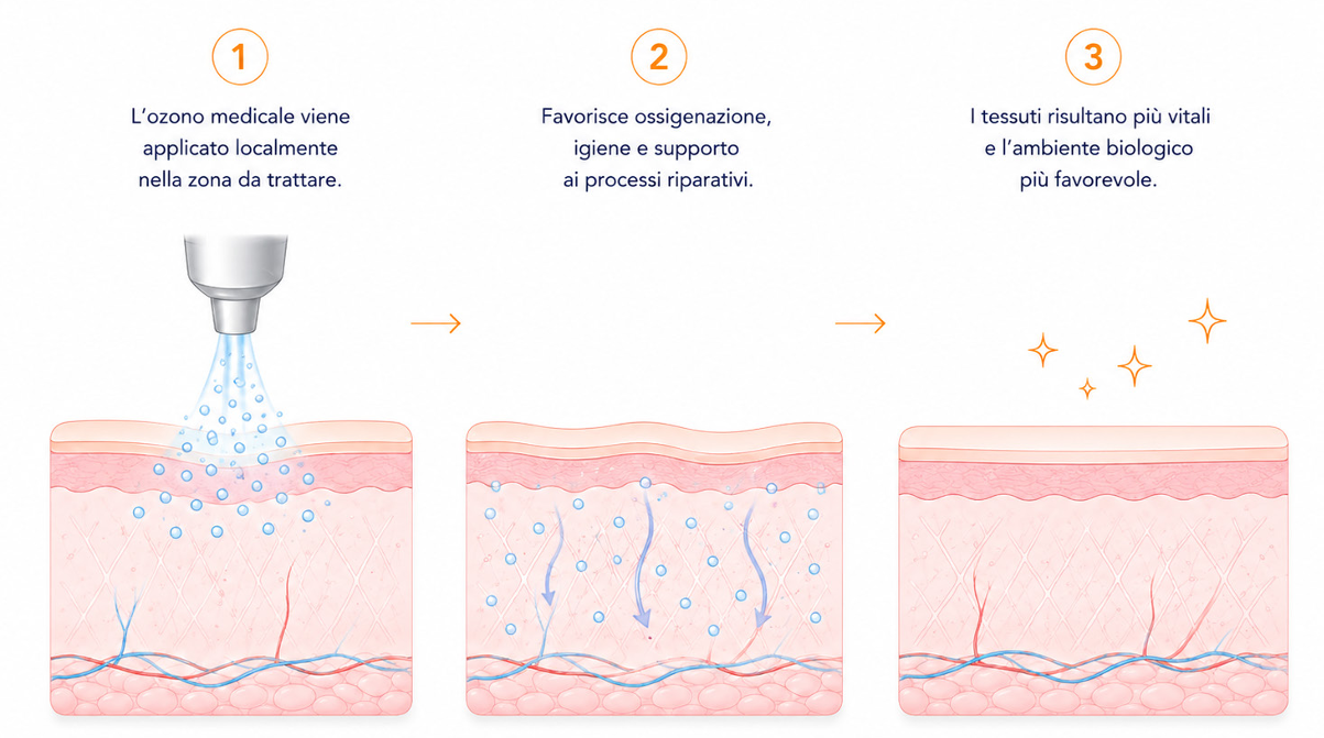 Schema in tre passaggi dell’ozonoterapia