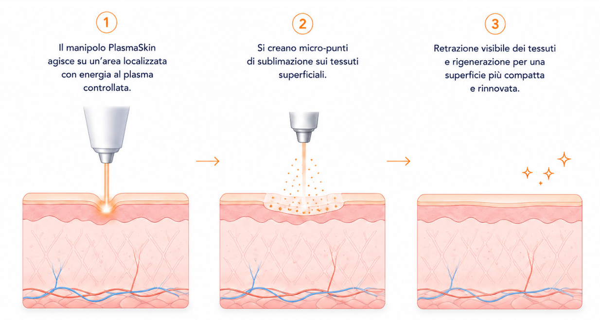 Schema in tre passaggi del trattamento PlasmaSkin
