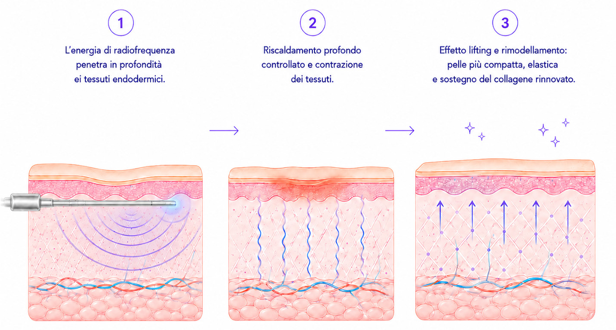 Schema in tre passaggi della radiofrequenza endodermica lift