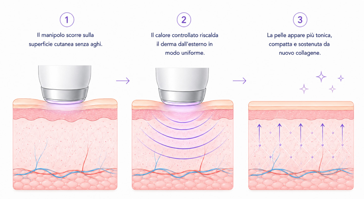 Schema in tre passaggi della radiofrequenza esodermica